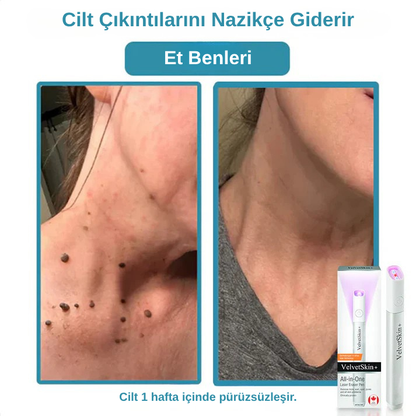 VelvetSkin+™ Hepsi Bir Arada CO₂ Lazer Silici Kalem | Benleri, Siğilleri, Cilt Kusurlarını ve Pigmentasyonları Giderir