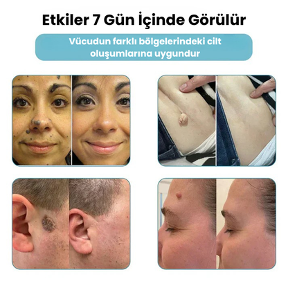 VelvetSkin+™ Hepsi Bir Arada CO₂ Lazer Silici Kalem | Benleri, Siğilleri, Cilt Kusurlarını ve Pigmentasyonları Giderir