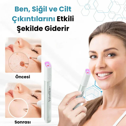 VelvetSkin+™ Hepsi Bir Arada CO₂ Lazer Silici Kalem | Benleri, Siğilleri, Cilt Kusurlarını ve Pigmentasyonları Giderir