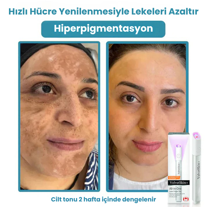 VelvetSkin+™ Hepsi Bir Arada CO₂ Lazer Silici Kalem | Benleri, Siğilleri, Cilt Kusurlarını ve Pigmentasyonları Giderir