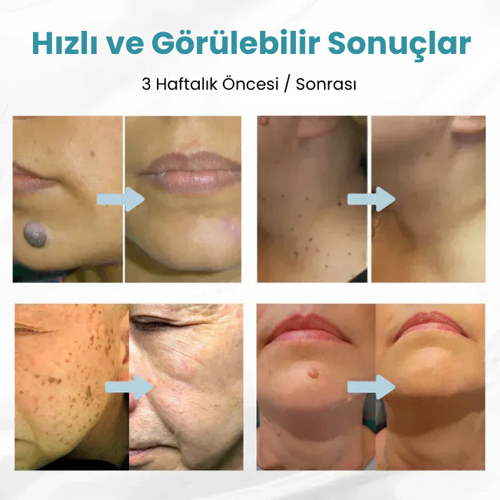 VelvetSkin+™ Hepsi Bir Arada CO₂ Lazer Silici Kalem | Benleri, Siğilleri, Cilt Kusurlarını ve Pigmentasyonları Giderir