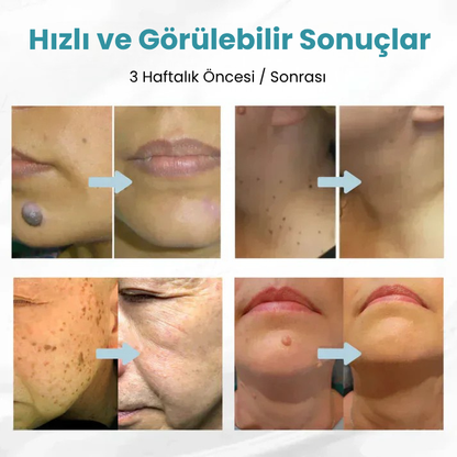 VelvetSkin+™ Hepsi Bir Arada CO₂ Lazer Silici Kalem | Benleri, Siğilleri, Cilt Kusurlarını ve Pigmentasyonları Giderir