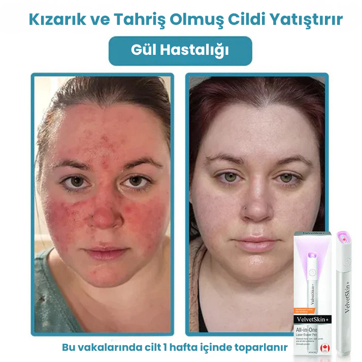 VelvetSkin+™ Hepsi Bir Arada CO₂ Lazer Silici Kalem | Benleri, Siğilleri, Cilt Kusurlarını ve Pigmentasyonları Giderir